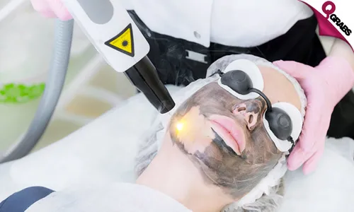 Carbon Laser Facial Treatment!